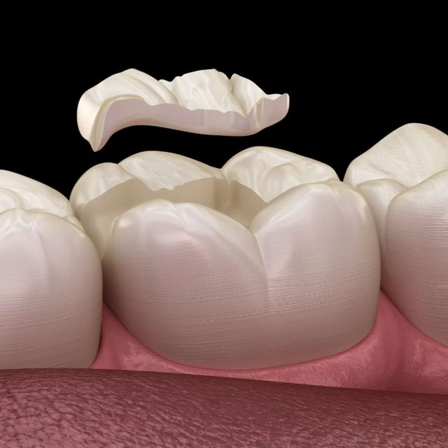 Dentista A Firenze Esperto In Intarsi Dentali