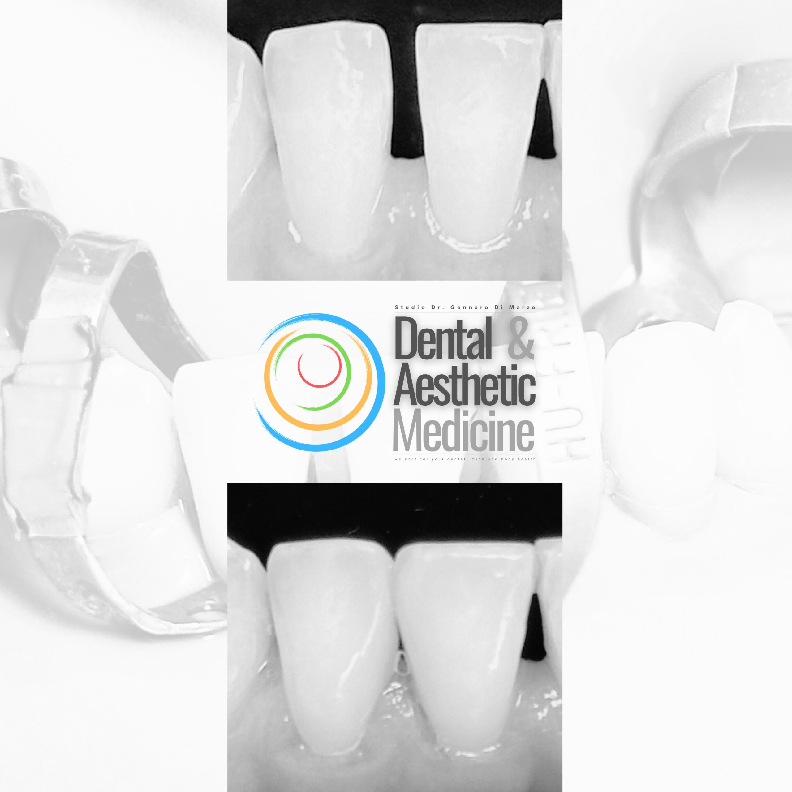 Arianna P. Post IG Immagini ravvicinate di faccette senza limare i denti prima e dopo l'applicazione, con il logo colorato di una clinica dentale e il testo "Dental & Aesthetic Medicine" al centro.