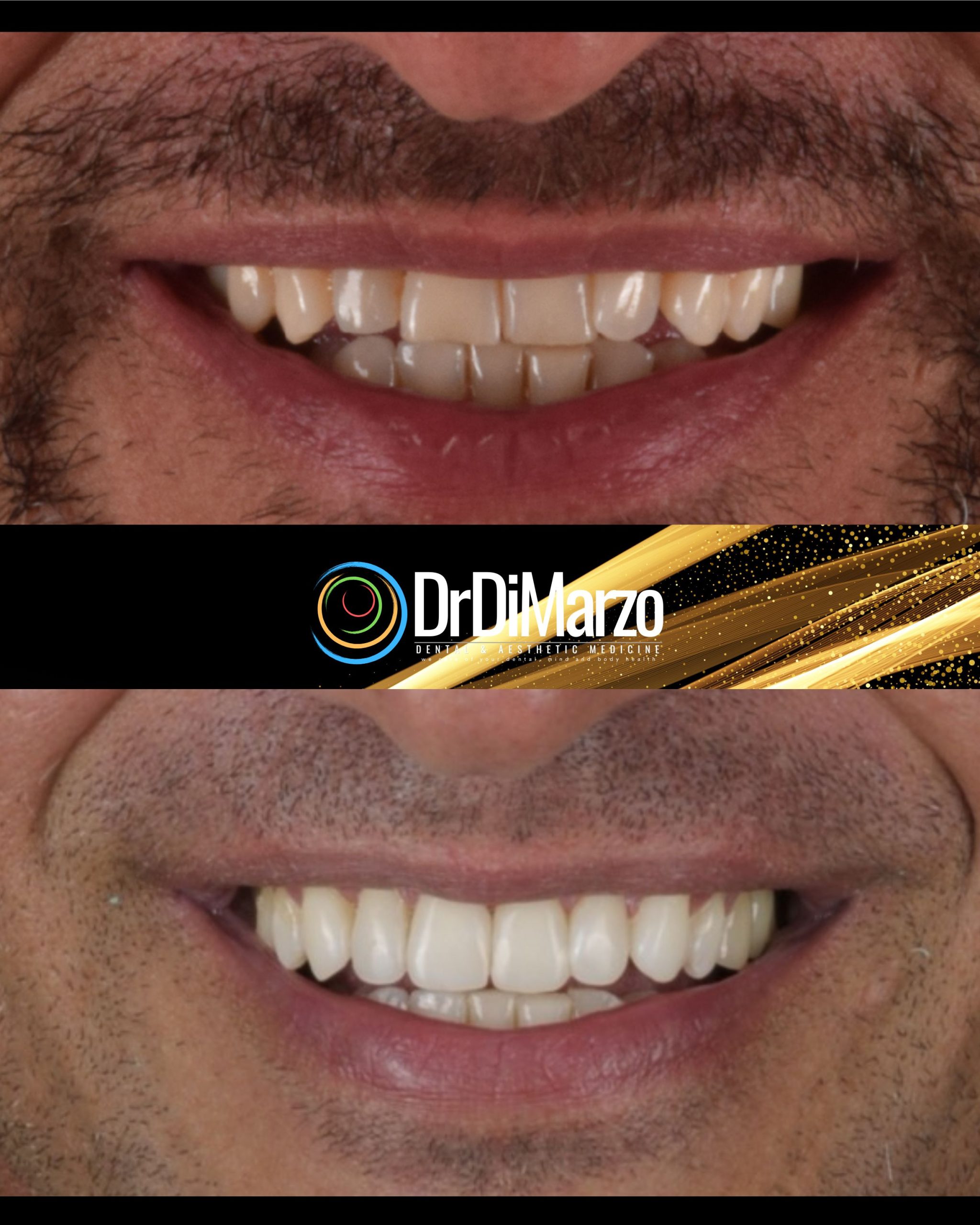 Tommaso T. Un'immagine prima e dopo mostra il sorriso di una persona trasformato con Faccette senza calcare i denti. La parte superiore rivela denti irregolari e scoloriti; la parte inferiore rivela denti più bianchi e più dritti. Il logo DrDiMarzo appare tra le immagini.