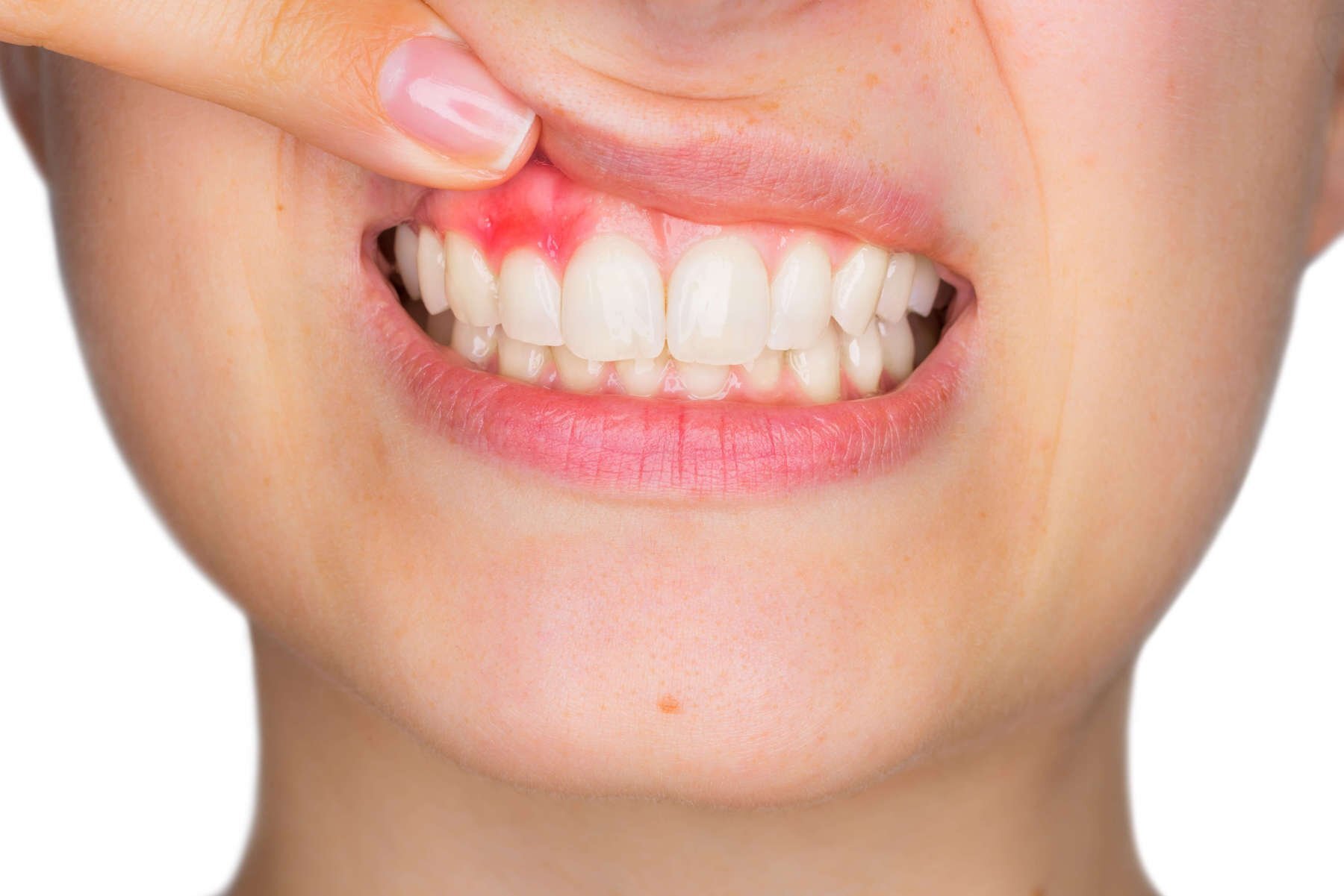 Dentista A Firenze Per Trattamento Della Parodontite 1 Dentista A Firenze Per Trattamento Della Parodontite 1