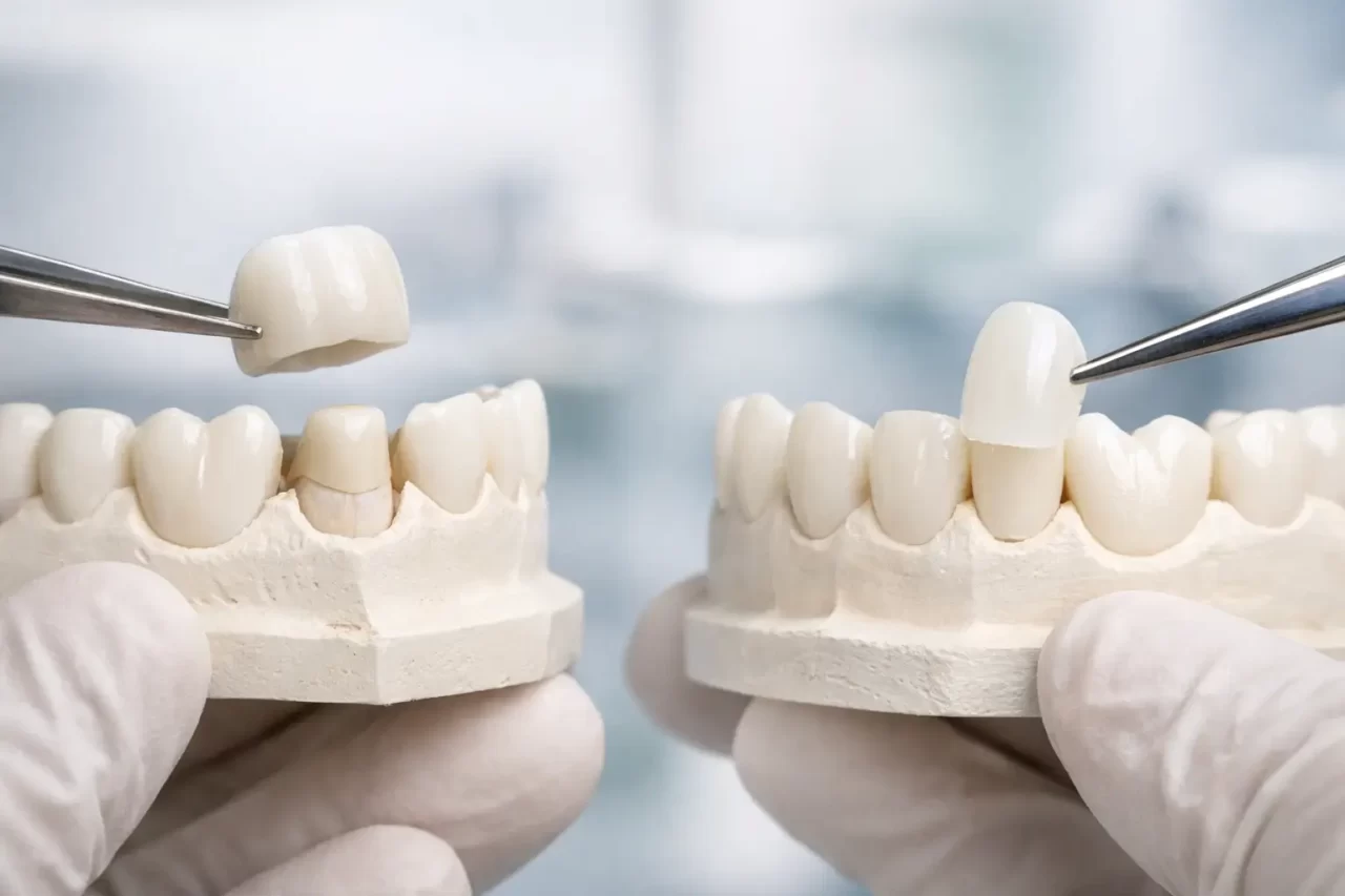 Corona dentale o faccetta: quale scegliere?